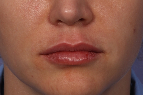 Lip Augmentation before and after photo