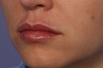 Lip Augmentation Before and after photo