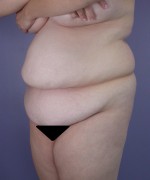 Liposuction Before and after photo