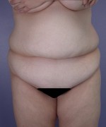 Liposuction Before and after photo