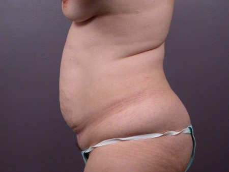 Liposuction before and after photo