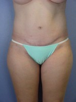 Liposuction Before and after photo