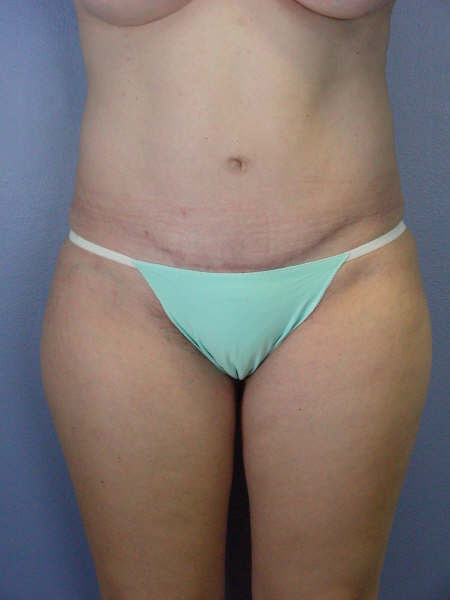 Liposuction before and after photo