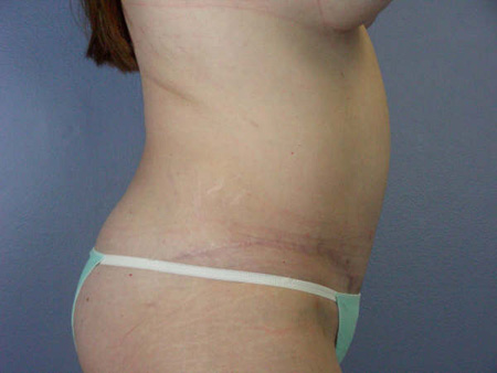 Liposuction before and after photo