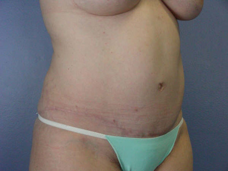 Liposuction before and after photo