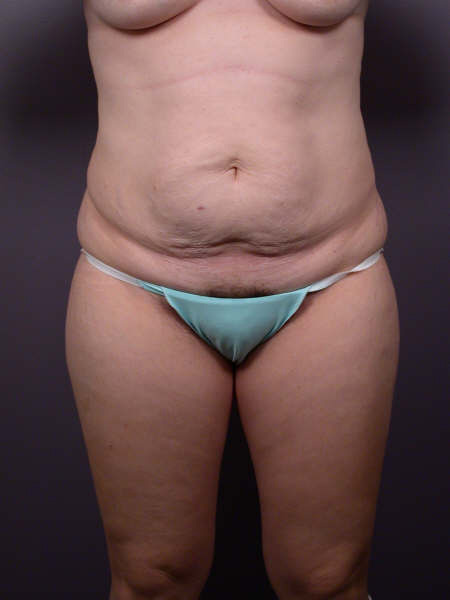 Liposuction before and after photo