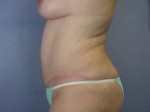 Liposuction Before and after photo