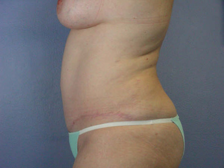 Liposuction before and after photo