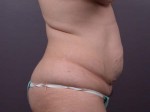 Liposuction Before and after photo