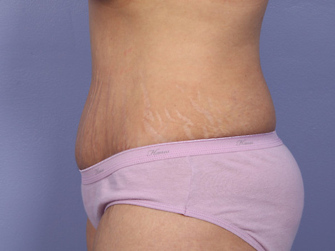 Liposuction before and after photo