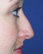 Nose Reshaping