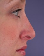 Nose Reshaping Before and after photo