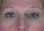 Eyelid Surgery