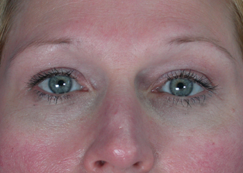 Eyelid Surgery before and after photo