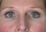 Eyelid Surgery