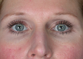 Eyelid Surgery before and after photo