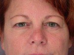 Eyelid Surgery Before and after photo