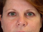 Eyelid Surgery