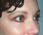 Eyelid Surgery Before and after photo