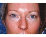 Eyelid Surgery Before and after photo