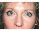 Eyelid Surgery