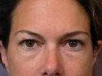 Eyelid Surgery Before and after photo