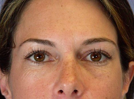 Eyelid Surgery before and after photo