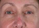 Eyelid Surgery