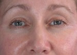 Eyelid Surgery