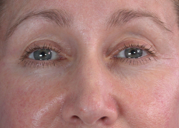 Eyelid Surgery before and after photo