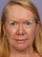 Facelift Before and after photo