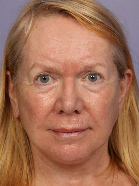 Facelift before and after photo