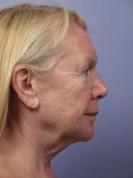 Facelift Before and after photo