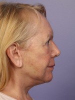 Facelift Before and after photo