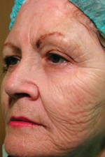 ThermaCool Non-Surgical Facelift