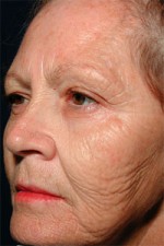 ThermaCool Non-Surgical Facelift Before and after photo