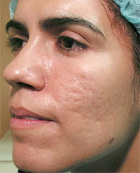 ThermaCool Non-Surgical Facelift before and after photo