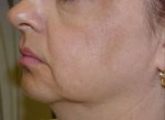 ThermaCool Non-Surgical Facelift Before and after photo