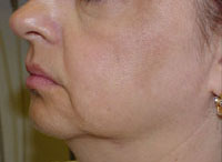 ThermaCool Non-Surgical Facelift before and after photo