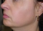 ThermaCool Non-Surgical Facelift Before and after photo