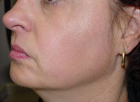 ThermaCool Non-Surgical Facelift before and after photo