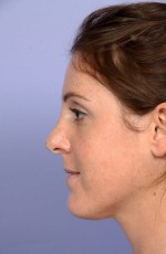 Nose Reshaping Before and after photo