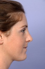 Nose Reshaping Before and after photo