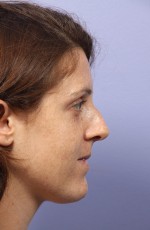 Nose Reshaping Before and after photo