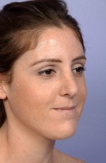 Nose Reshaping Before and after photo