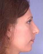 Nose Reshaping Before and after photo