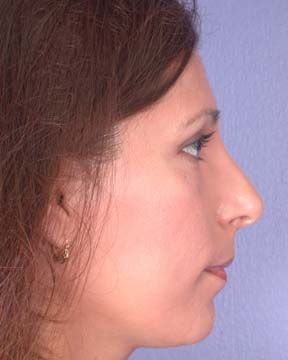 Nose Reshaping before and after photo