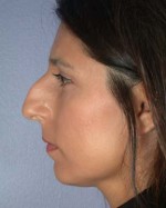 Nose Reshaping Before and after photo