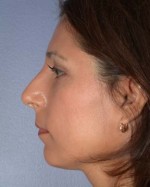 Nose Reshaping Before and after photo