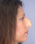 Nose Reshaping Before and after photo